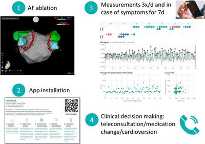 Photoplethysmography-documented atrial fibrillation in the first week after catheter ablation is associated with lower success rates